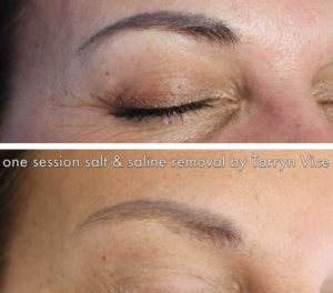 Permanent make up correction and removal