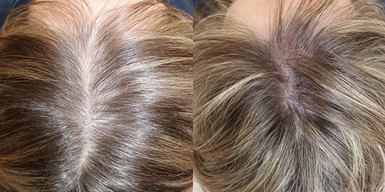 scalp Micro